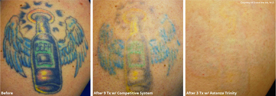 Before and After Photos - Vanish Laser Clinic Alexandria VA