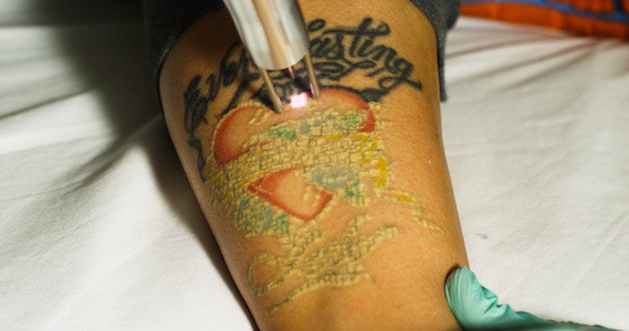 laser tattoo removal in alexandria, virginia
