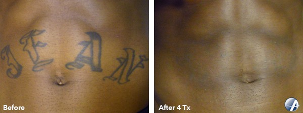 laser tattoo removal Arlington, Virginia