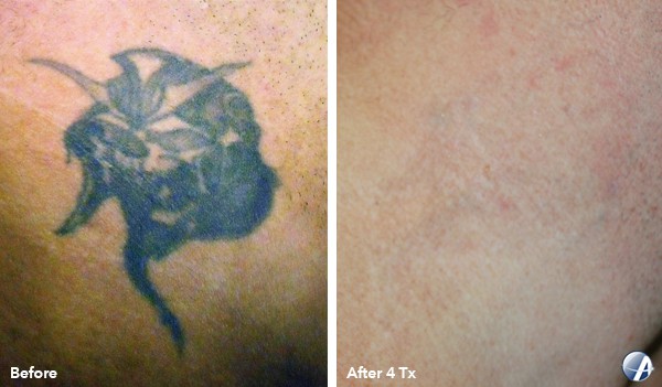 laser tattoo removal Arlington, Virginia