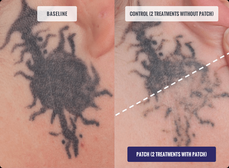 Shorten your Tattoo Removal Duration with the new PFD Patch - Vanish Laser  Clinic Alexandria VA