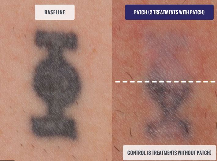 Accelerated Tattoo Removal Treatment - Vanish Laser Clinic Alexandria VA