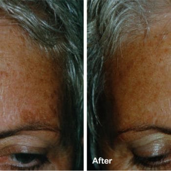 Pigmented Lesion Removal - Vanish Laser Clinic Alexandria VA