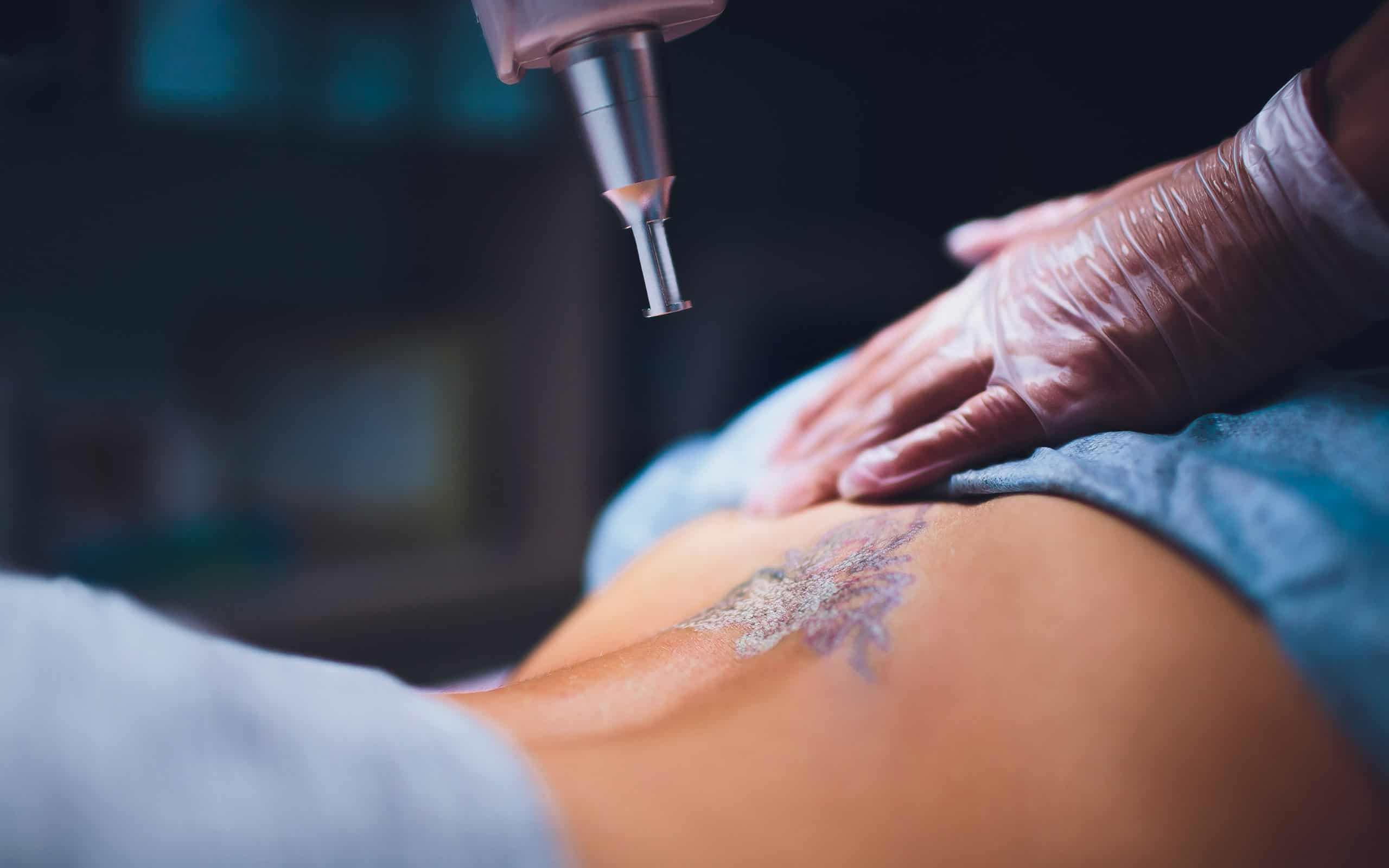 Consider Laser Tattoo Removal for a Cover-up Tattoo - Vanish Laser Clinic Alexandria VA